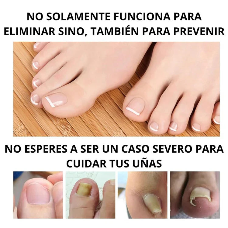 Toenail Plus | Tratamiento para eliminar hongos de uña 100% natural